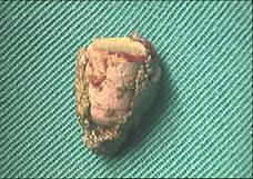 Rubber-tip pencil eraser identified as the core of the rhinolith