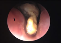 Yellowish hard mass which is later identified as rhinolith
