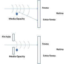 Figure 1: Monocular diplopia due to light diffraction resolved with pinhole
