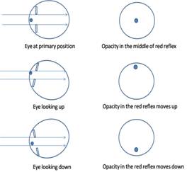 Figure 3: Movement of opacity in red reflex for media opacity in front of pupillary plane