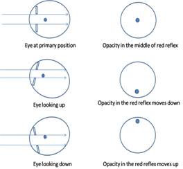 Figure 4: Movement of opacity in red reflex for media opacity behind the pupillary plane