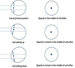 Figure 5: No movement of opacity in red reflex for media opacity in the pupillary plane