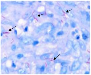 Biopsies of the prostatic wall