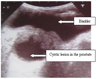 ultrasounds showed a small bladder and an irregular cystic lesion in the prostate