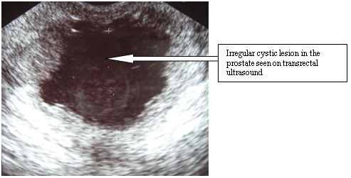ultrasounds showed an irregular cystic lesion in the prostate