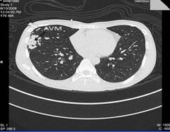 CT scan of the chest
