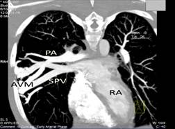 reconstruction of CT pulmonary angiogram