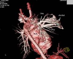 reconstruction of CT pulmonary angiogram