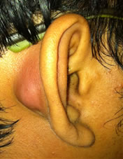 Infected post-auricular cyst