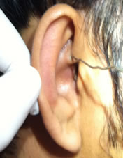 limb of helix