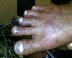 foot of an adult male with Hepatitis C virus