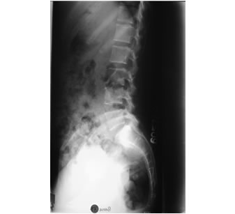 Spine x-ray