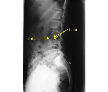 Spine x-ray