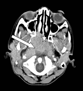 Axial CT scan showed mass at nasopharyngeal