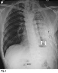 Left fibrothorax with calcification of visceral pleura and trapped lung