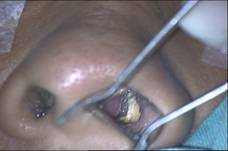 Anterior rhinoscopy revealed a yellowish mass