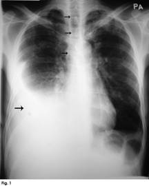 Chest radiograph