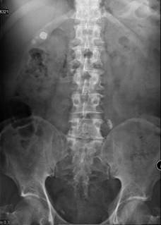 Kidney ureter bladder radiograph