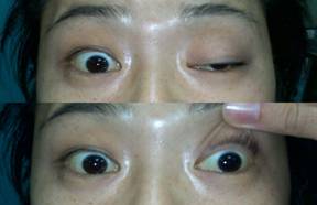 left eye ptosis