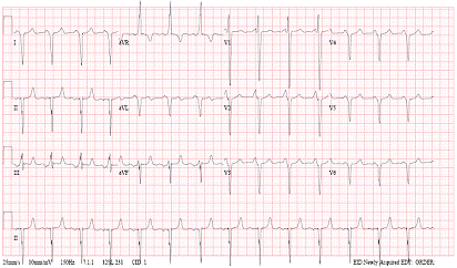 ECG