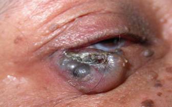 Basal cell carcinoma