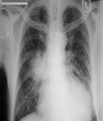 Chest radiograph