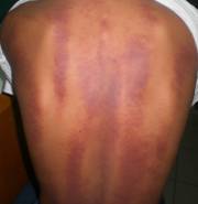Large areas of ecchymoses as a result of coining