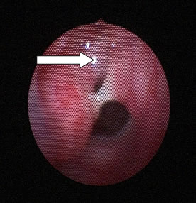 Endoscopic view of nasopharynx from right nostril