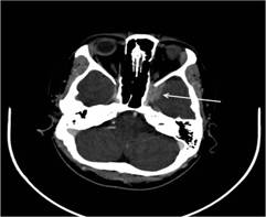 Axial view of brain CT