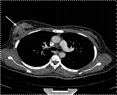 Axial view of thorax CT