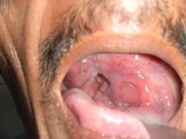 Oral cavity
