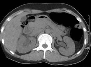 Bilateral hydronephrosis