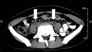 Bilateral hydroureter