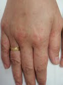 Figure 2 - dorsum of hand