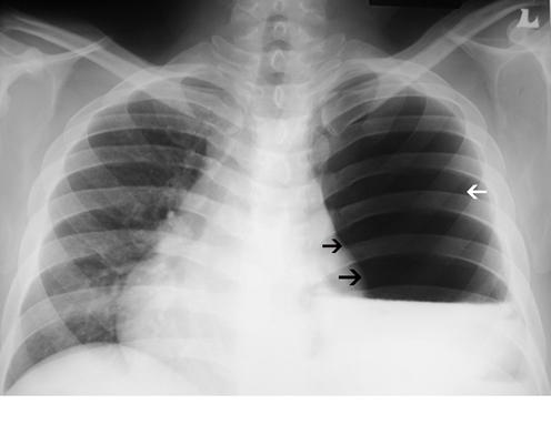 A left-sided hydropneumothorax (white arrow) with complete collapse of the left lung (black arrows)
