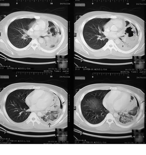 Figure 3. High-resolution (HRCT) scan of the chest showing areas of cavitation in the semi-expanded left lung (gray arrows) and presence of a left-sided pleural effusion (gray arrow)
