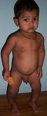 Figure 1. A child with bilateral bowing of leg