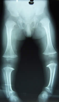 Figure 2. Radiograph of the lower limb 