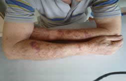 Side view of both forearms