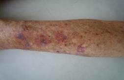 Closer dorsal view of right forearm