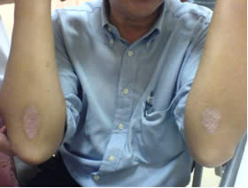 Psoriatic plaques