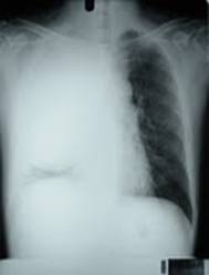 figure 1 chest radiograph