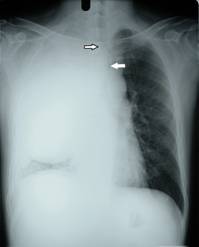 Figure 2 - chest radiograph