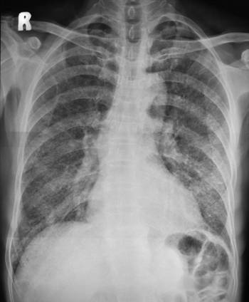 Chest radiograph 
