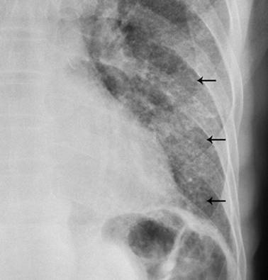 Chest radiograph 