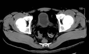 Thickened bladder wall with dilatation of the lower ureters