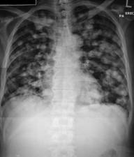 Chest radiograph