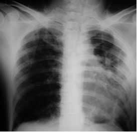 Chest radiograph