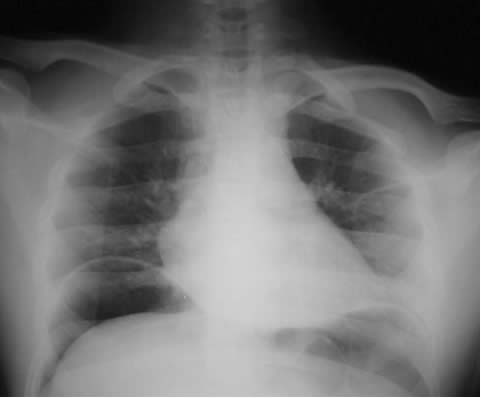 Factory worker chest radiograph