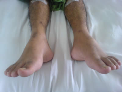 Foot Drop patient